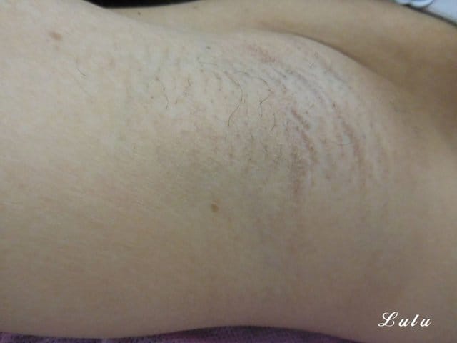 博美名人外科診所。拒絕夏日毛手毛腳，毛絨絨。雷射除毛推薦。Duetto雙效激光雷射