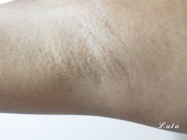 博美名人外科診所。拒絕夏日毛手毛腳，毛絨絨。雷射除毛推薦。Duetto雙效激光雷射