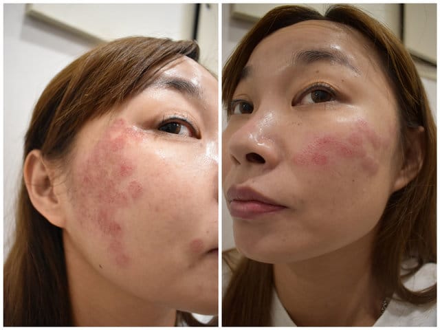 媄婧美學診所。專業醫師諮詢＆操作。價格合理。PICOCARE 皮秒雷射。 除斑、毛孔問題、細紋，促進膠原蛋白增生。一週後的肌膚Q彈緊緻，跟老化的下垂型毛孔說Bye
