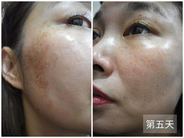 媄婧美學診所。專業醫師諮詢＆操作。價格合理。PICOCARE 皮秒雷射。 除斑、毛孔問題、細紋，促進膠原蛋白增生。一週後的肌膚Q彈緊緻，跟老化的下垂型毛孔說Bye
