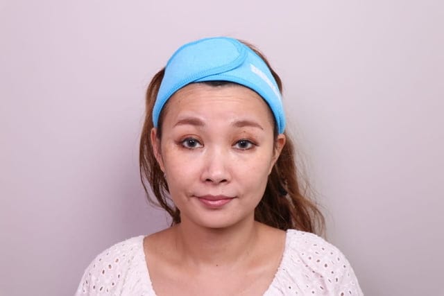 表情誇張的動態紋，小心變成靜態紋，後悔莫及！？#佳思優整形醫美診所。讓郭聿書醫師，施打肉毒除皺，全程紀錄，心得分享