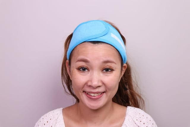 表情誇張的動態紋，小心變成靜態紋，後悔莫及！？#佳思優整形醫美診所。讓郭聿書醫師，施打肉毒除皺，全程紀錄，心得分享