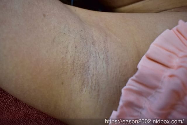 桃園美容SPA。#恩蓓拉WAXING 中正館。舉手掰掰不用怕。腋下熱蠟除毛
