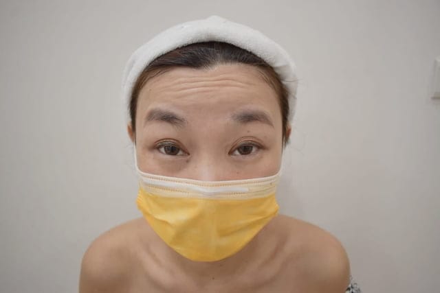 板橋肉毒推薦。＃法邑極緻美學診所。快速終極你的抬頭紋，拍照不用開美肌，也能美美der