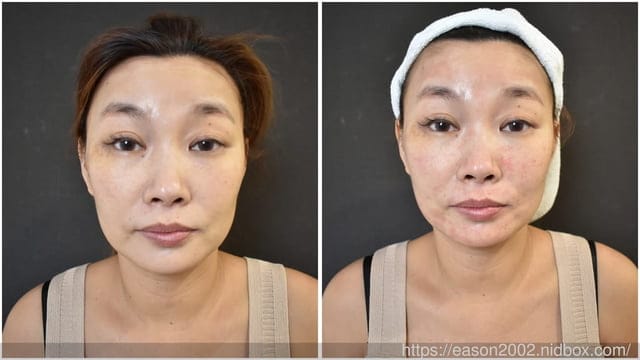 探索皮秒分享 | 愛爾麗診所站前店 貼心專業醫師諮詢建議 恢復期快 拍照不開美肌，也能完美無瑕