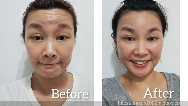 台北水光槍推薦 | 青熙美學診所 忠孝院所 海庫斯水光槍 +肉毒除皺（抬頭紋）潤澤、緊緻、平滑 快速達成